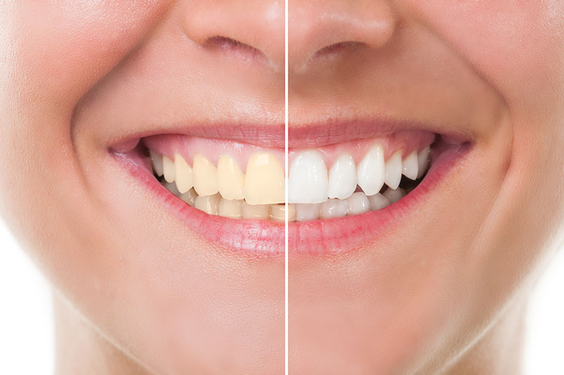 Teeth Whitening - Smiles on Maple, Zanesville Dentist